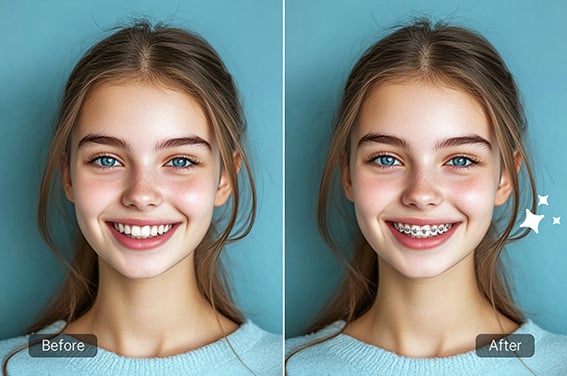 Braces Try-On