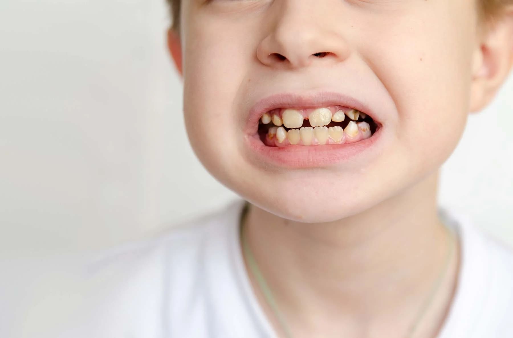 Biological Weakness Causing Yellow Teeth 